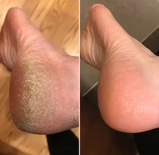 Antes e depois 3