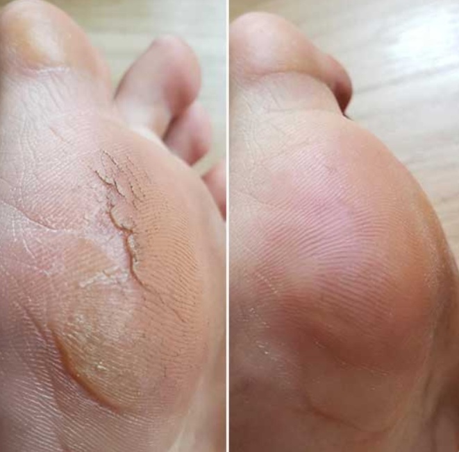 Antes e depois 2