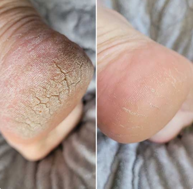Antes e depois 1